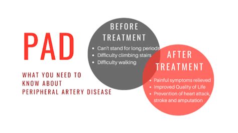 Smoking And Peripheral Artery Disease PAD