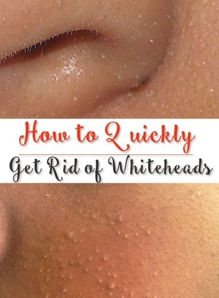 How To Get Rid Of Whiteheads Healthy Mom