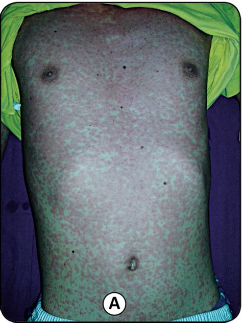 Scielo Brasil Maculopapular Rash And Kopliks Spots In Adult