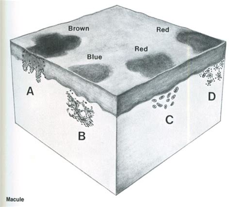 Identifying Skin Lesions Flashcards Quizlet