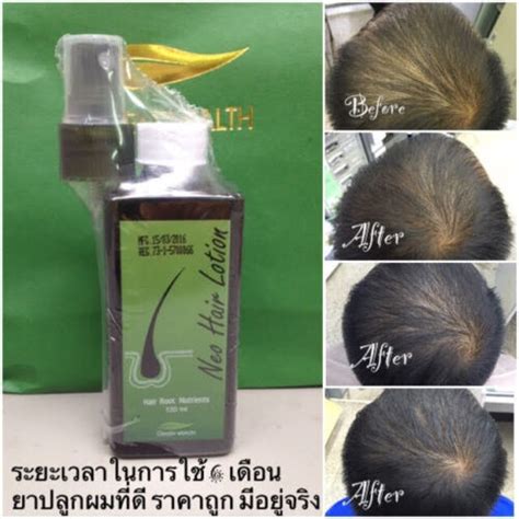 Buy X Green Wealth Neo Hair Lotion Hair Loss Growth Root Nutrients