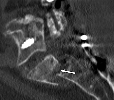 Sacral Fractures After Lumbosacral Fusion A Characteristic Fracture Pattern Ajr