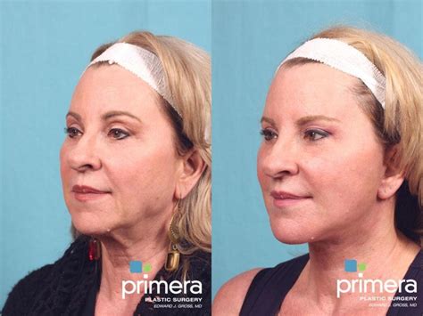 Facelift Before And After Pictures Case Orlando Florida