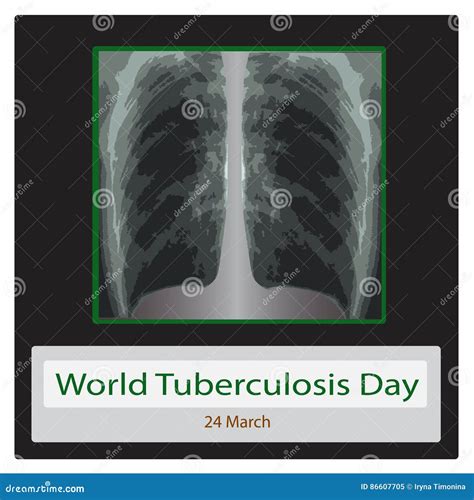 Tuberculosis Tb Infographics Vector Illustration Cartoondealer