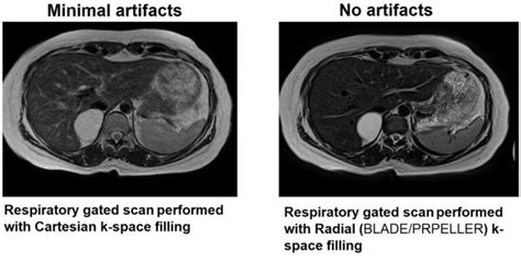 Mri Artifacts Mri Motion Artifact Ghosting Artifact Mri