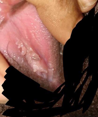 Anyone Can Explain What Are These Bump On My Vagina Is This Vestibular