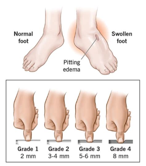 Edema Definitions Causes And Assessment