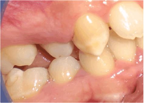 Gallium Arsenide Aluminium Laser In Esthetic Dentistry