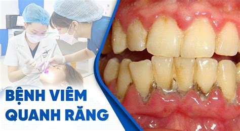 Cảnh báo Viêm quanh răng và những biến chứng nguy hiểm