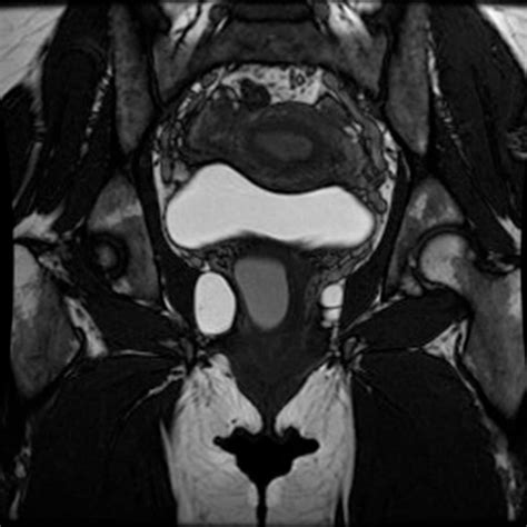 Infected Gartner Duct Cyst