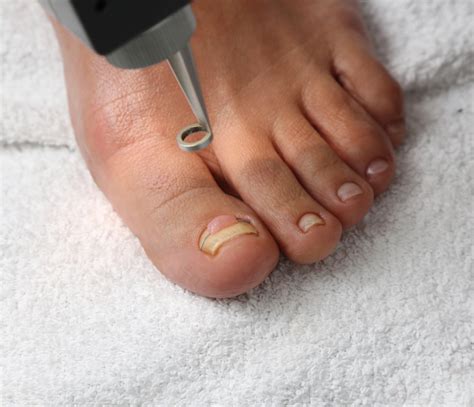 Bellbowrie Podiatrist Advance Foot Clinic Podiatry