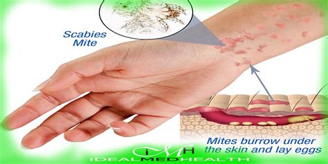 Pathophysiology Of Scabies Nbkomputer