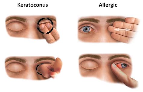 What Is Keratoconus Eye Disease Treatments For Keratoconus