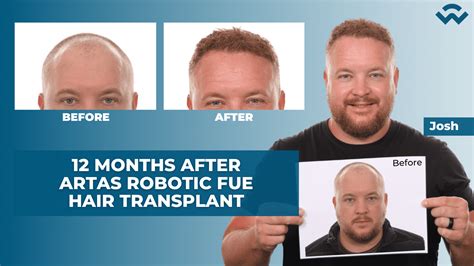 Year After Hair Transplant Artas Robotic Fue We Grow Hair Indy