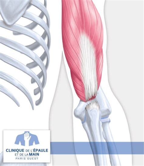 Rupture Du Triceps Clinique De L Epaule Et De La Main Paris