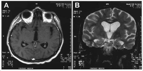 Neurosyphilis Mri