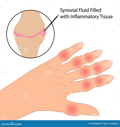 Rheumatoid Arthritis on Fingers Medical Vector Illustration Stock ...