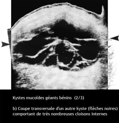 Pathologie Organique De L Ovaire Chographie Dr Kara Zaitri M A