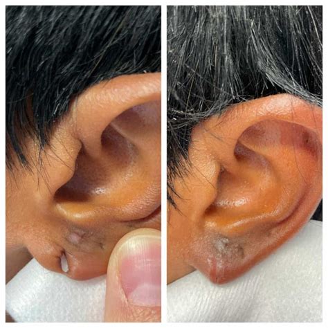 Otoplasty St Louis Ear Plastic Surgery St Louis Ear Reduction