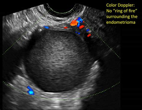 Hemorrhagic Ovarian Cysts One Entity With Many Appearances Mdedge Obgyn