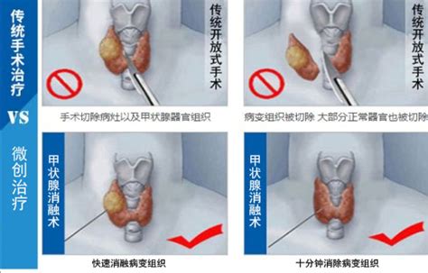 甲状腺消融术做完说话大山谷图库