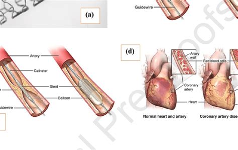 A Fully Dilated Absorbable Stent Erne Et Al B Angioplasty