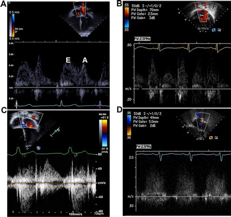 Representative Gradients And Doppler Flow Profiles From A Healthy Download Scientific Diagram