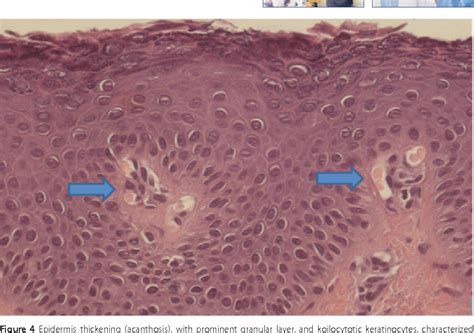 Epidermodysplasia Verruciformis Symptoms Causes Diagnosis And