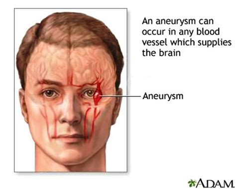 Brain Aneurysm Symptoms | MedicineBTG.com