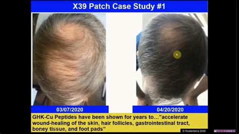 Hair Restoration Before And After 6 Weeks With Lifewave X39 Patches Dr Andrew Rostenberg Youtube