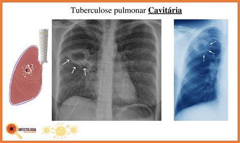 Tuberculose Saiba Mais Dra Keilla Freitas Infectologista Em Moema