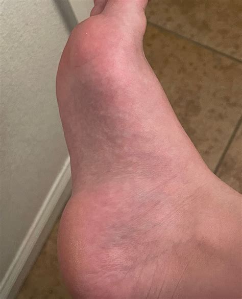 Hard Itchy Bumps On Foot Sale Emergencydentistry