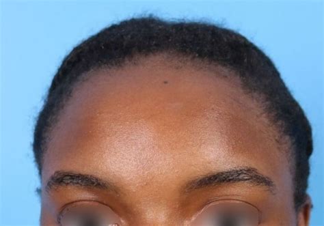 Forehead Reduction Before And After Raleigh Nc North Raleigh Plastic