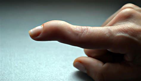 What Is Mallet Finger Op Dr Ibrahim KASAPOGLU