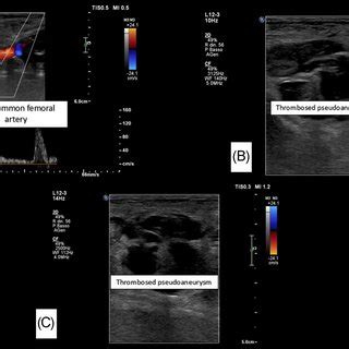 Main access pseudoaneurysm. (A) Ultrasound picture of the right ...