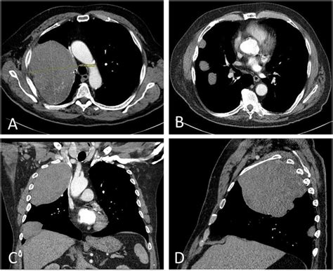 Computed Tomography With Axial A And B Coronal C And Sagittal D