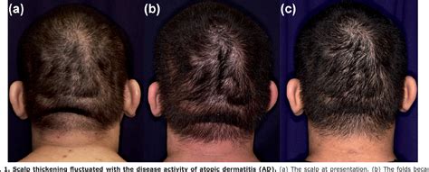 Cutis Verticis Gyrata Surgery Before And After