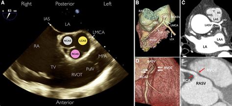 Right Ventricular Outflow Tract Anatomy