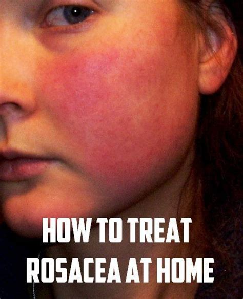 How To Treat Rosacea At Home How To Treat Rosacea Rosacea Hair Skin