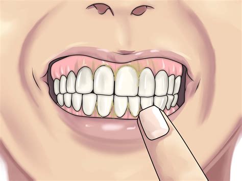 How To Prevent Fuzzy Teeth 12 Steps With Pictures Wikihow