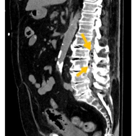 Non Contrast Ct Of The Abdomen And Pelvis Sagittal Section Download Scientific Diagram