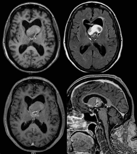 Colloid Cyst Axial And Sagittal T1 Weighted And Axial Flair Images Download Scientific Diagram