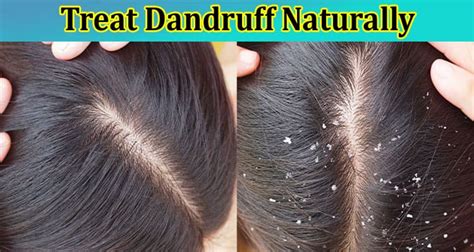 How To Treat Dandruff Naturally Get Complete Information Here