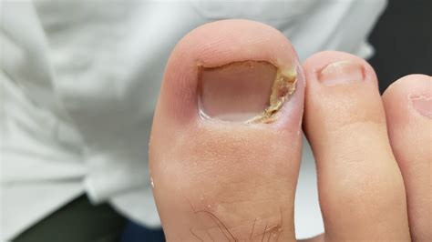 What Is An Ingrown Toenail