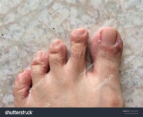 Toe Skin Peeling