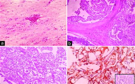 A Smears Showing Oncocytic Cells In Clusters Plenty Of Vacuolated Download Scientific