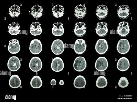 Intracranial Hemorrhage Ct Scan Ct Scan Machine Images