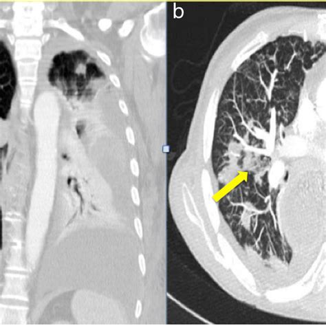 Chest Computed Tomography Showing A Multiple Nodular Opacities And