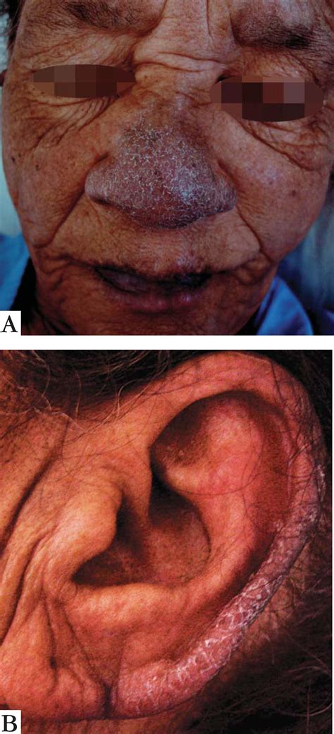 Bazex Syndrome