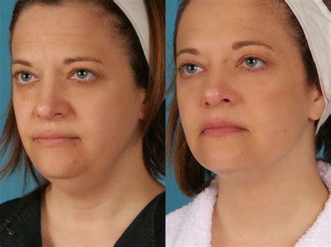 Perfect Body Laser And Aesthetics Neck Lift Jawline Contouring